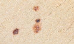 New Strategies Revealed in the Diagnosis of High Mitotic Rate Cutaneous Melanoma