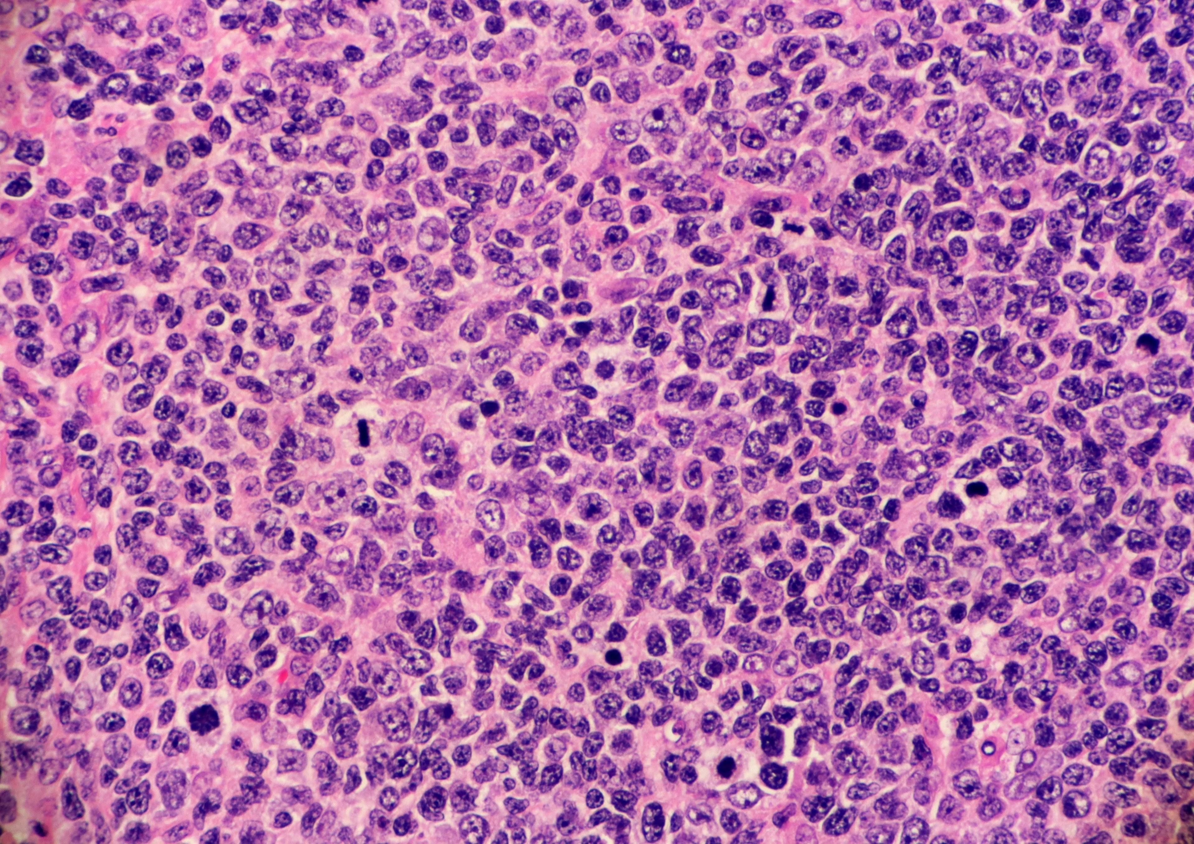 High grade follicular lymphoma with marginal zone differentiation. Multiple lymphocytes are undergoing mitosis. Microscopic view. | Image Credit: © Lisa - www.stock.adobe.com