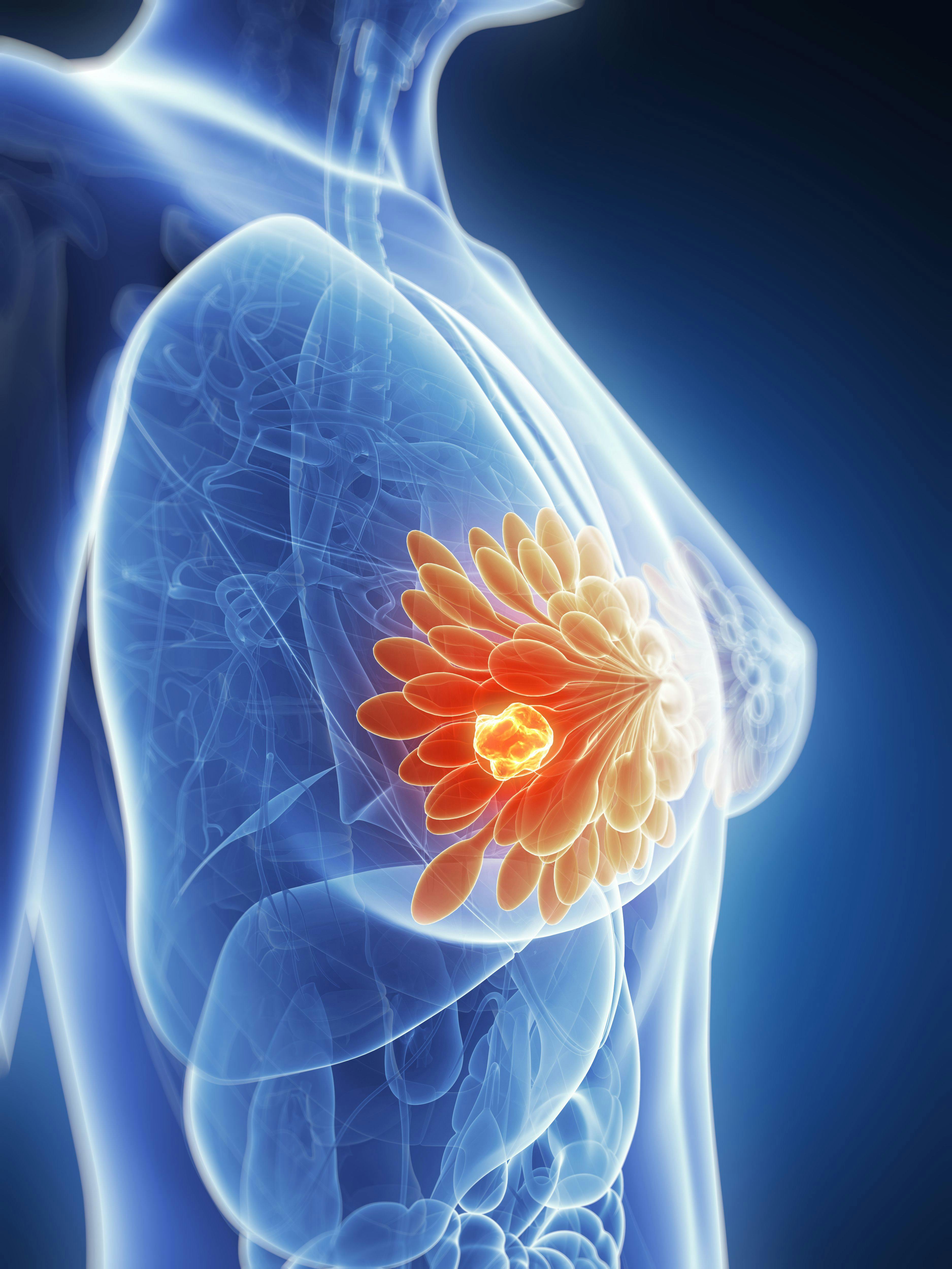 3d rendered illustration - breast cancer © SciePro - stock.adobe.com
