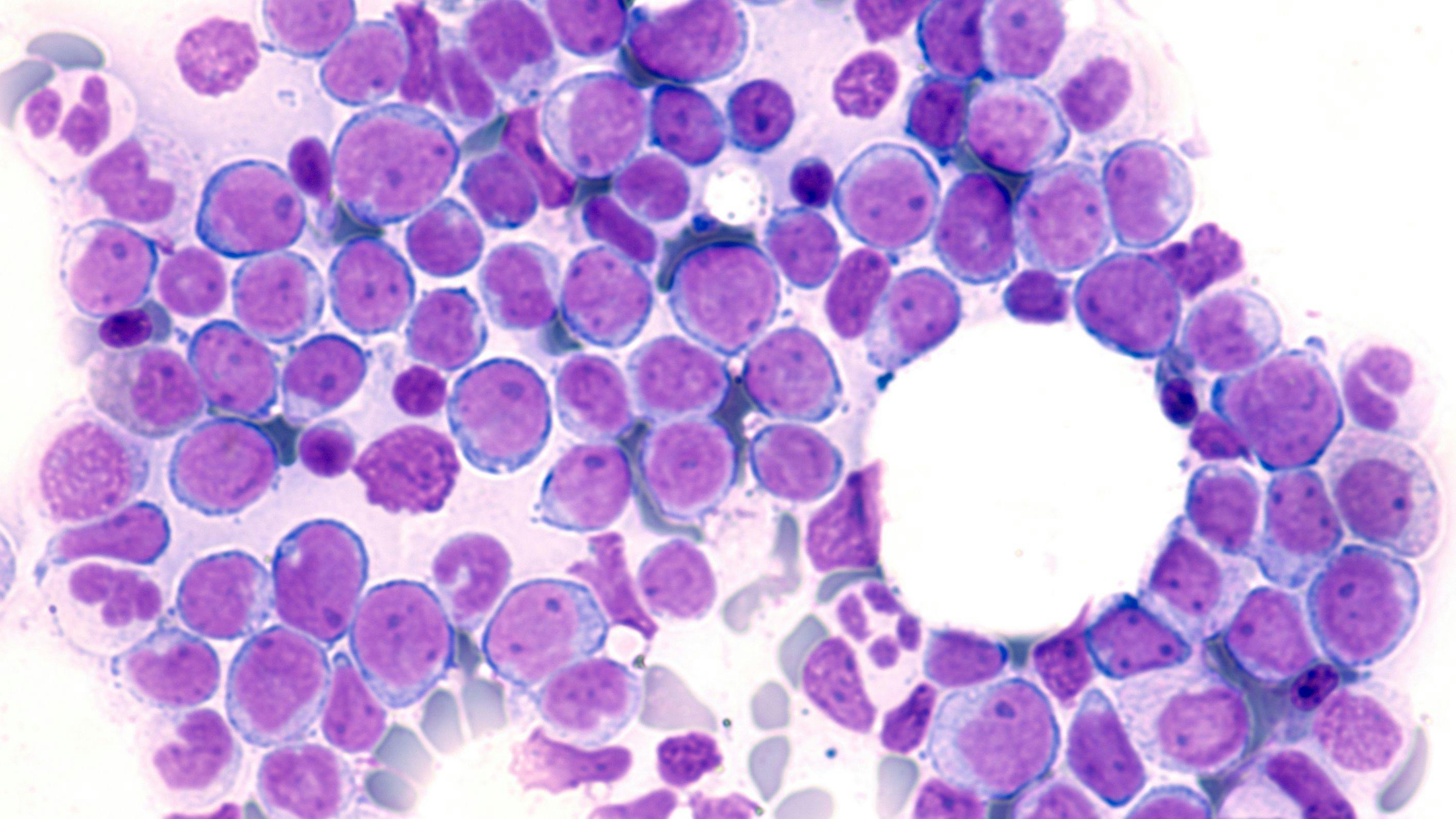 Leukemia Awareness: Photomicrograph of bone marrow aspirate showing myeloblasts of acute myeloid leukemia (AML), a cancer of white blood cells. | Image Credit: © David A Litman [stock.adobe.com] 