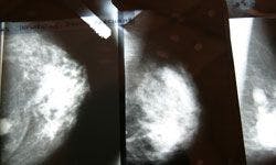 Breast Ultrasound Added to Mammography Increases Cancer Detection