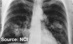 Effective Options Arise for Patients With ALK-Positive NSCLC