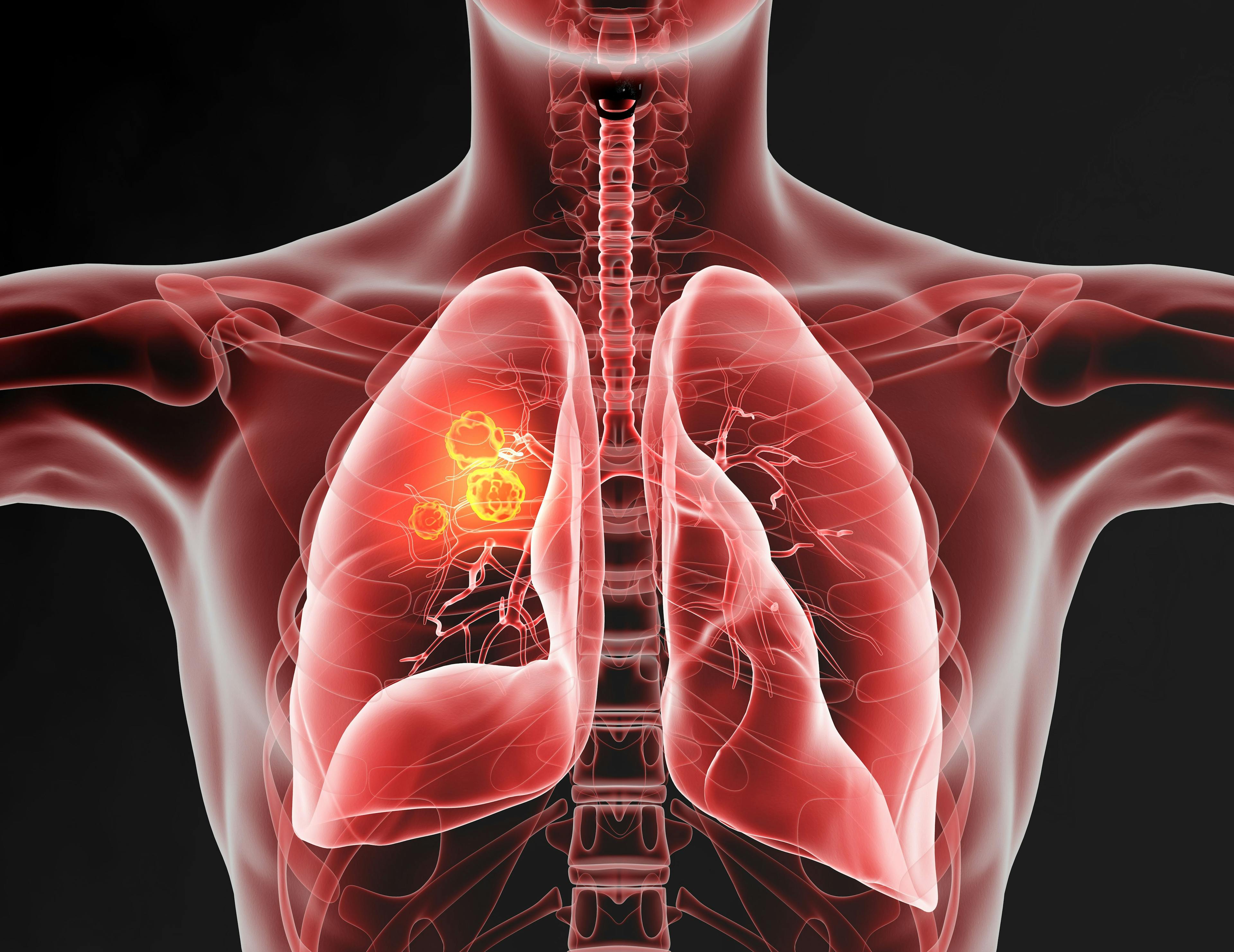 Lung cancer, medically accurate 3D illustration | Image Credit: © Axel Kock - www.stock.adobe.com