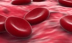 Elotuzumab Combination Demonstrates Benefit in Myeloma