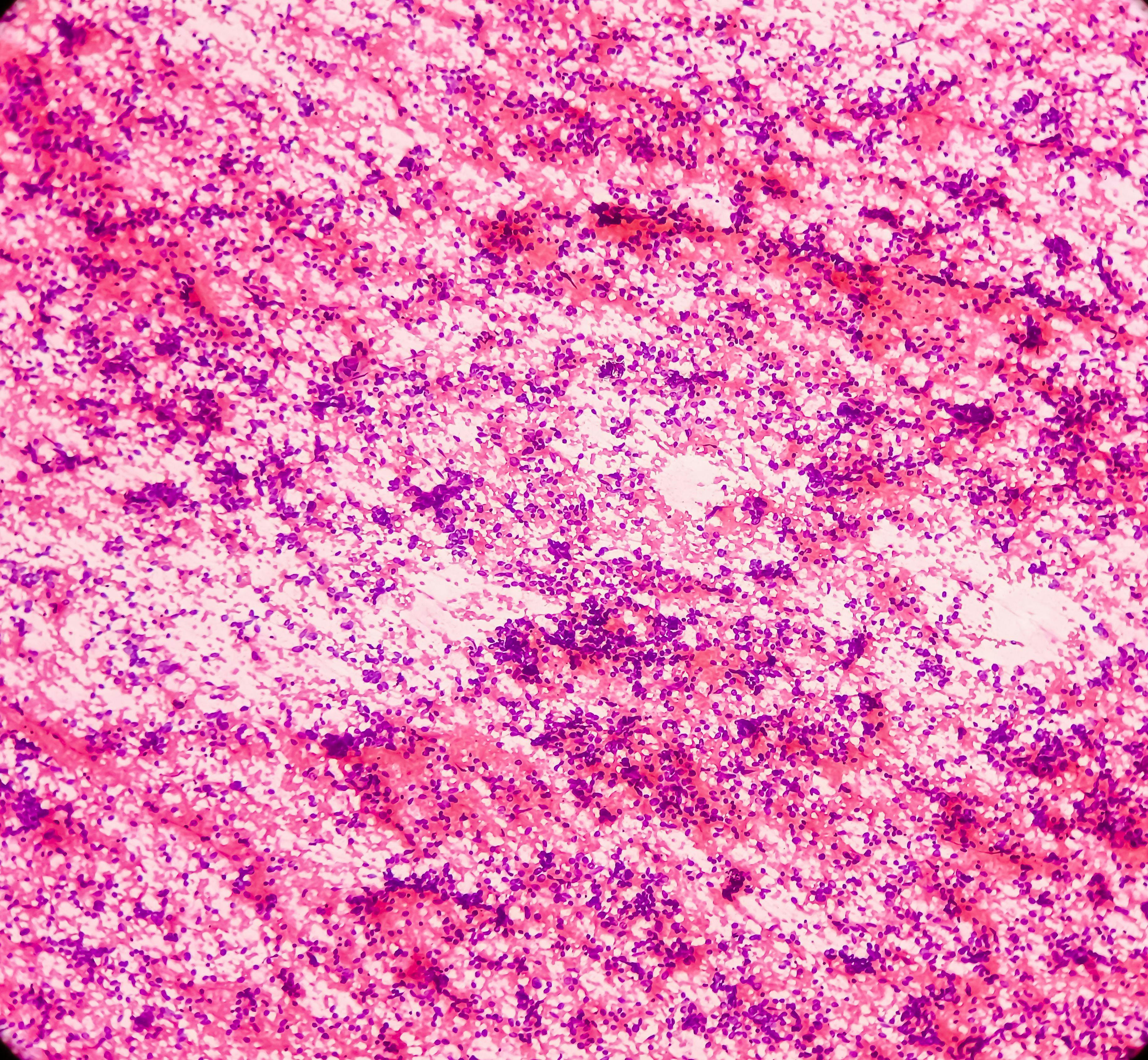 Lung cancer, photomicrograph of small cell carcinoma, malignant cells, sample sapirate from lung mass by CT guided FNA, show atypical small round cells, granular salt pepper chromatin | Image Credit: © MdBabul - www.stock.adobe.com