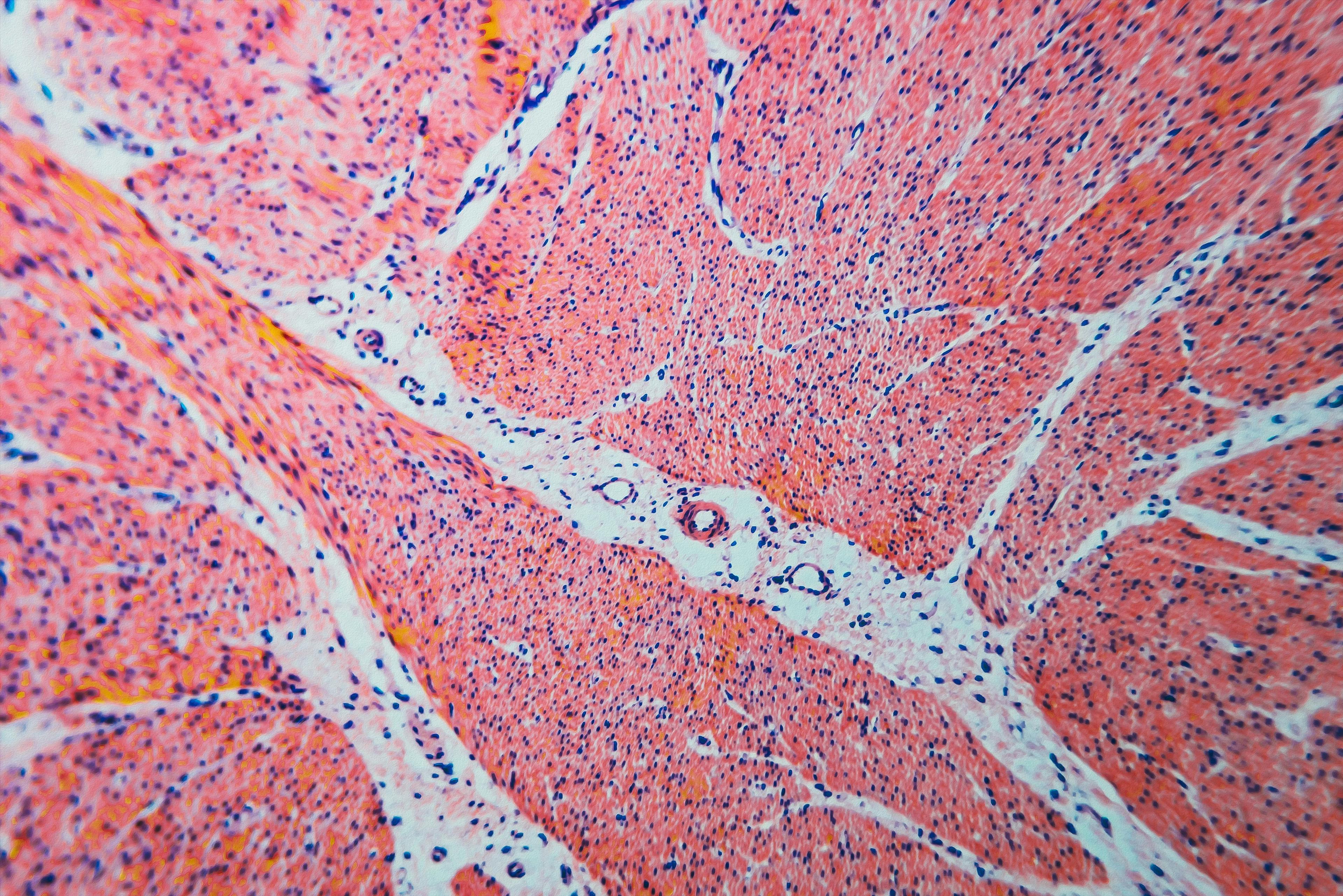[Cell microscopic- pyloric division stomach] | [Image Credit  © [Digital Photo] - [Adobe Stock], colorectal cancer under microscope