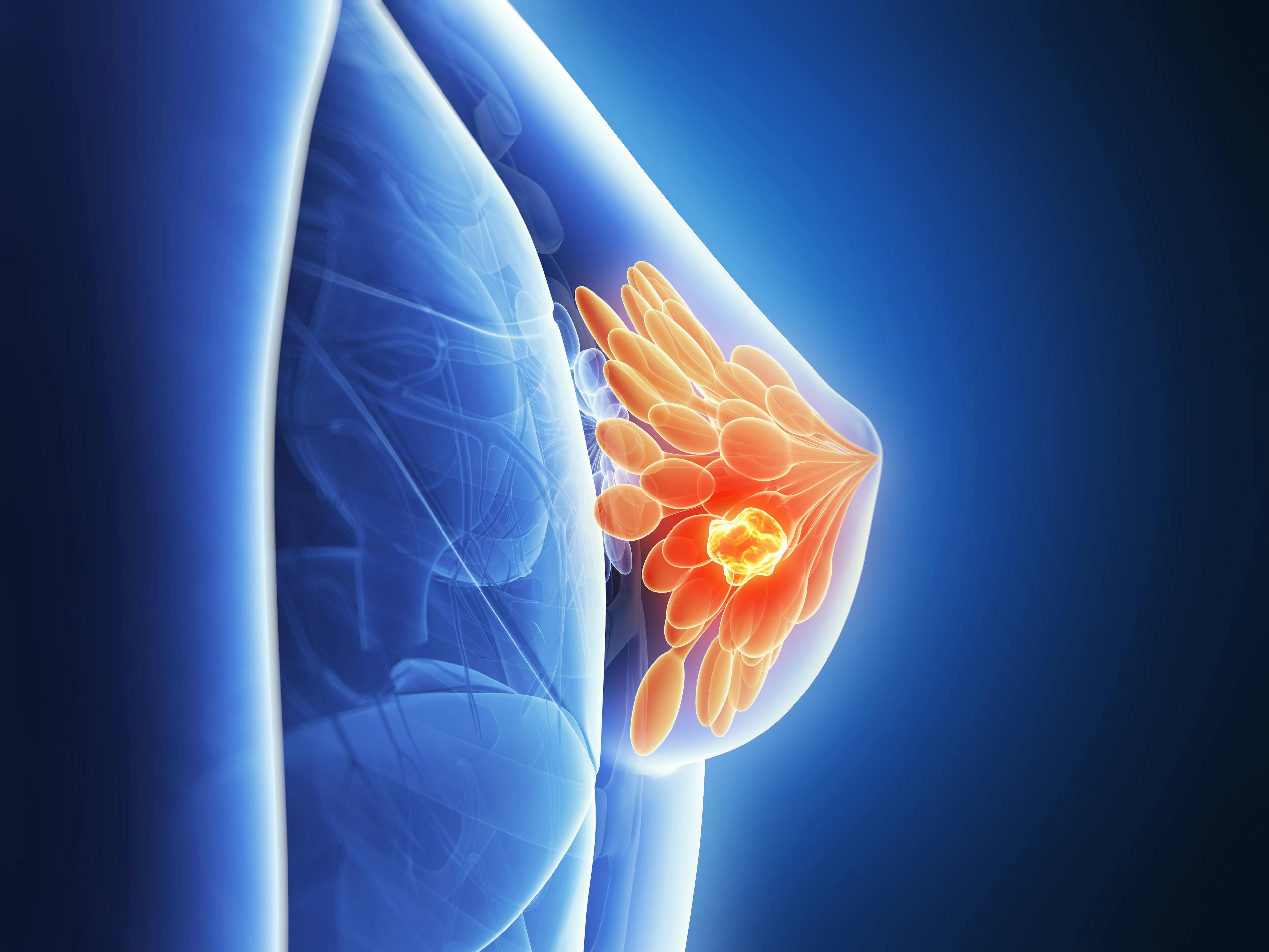 3D rendering of breast cancer
