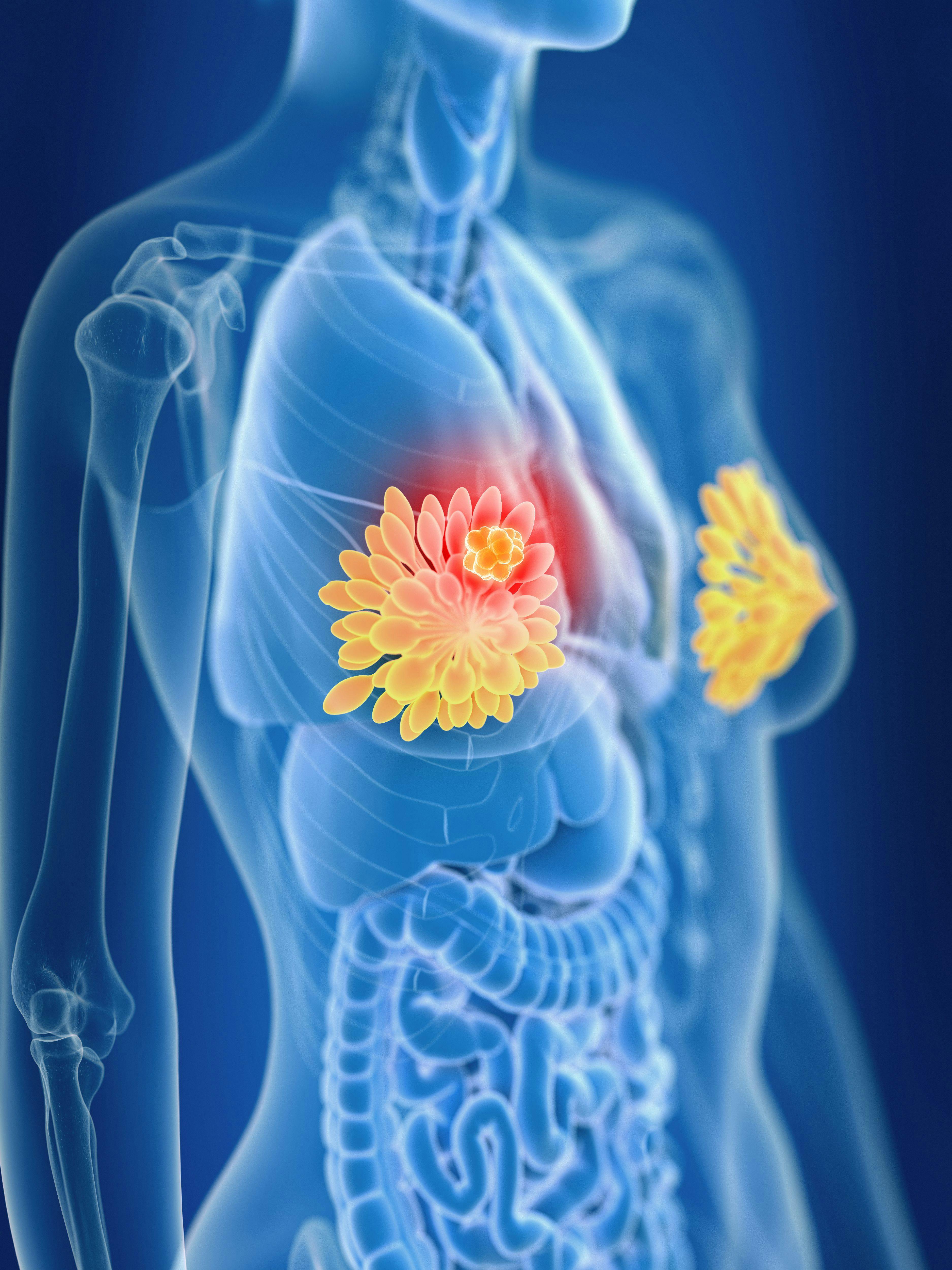3d rendered medically accurate illustration of a breast cancer: © SciePro - stock.adobe.com
