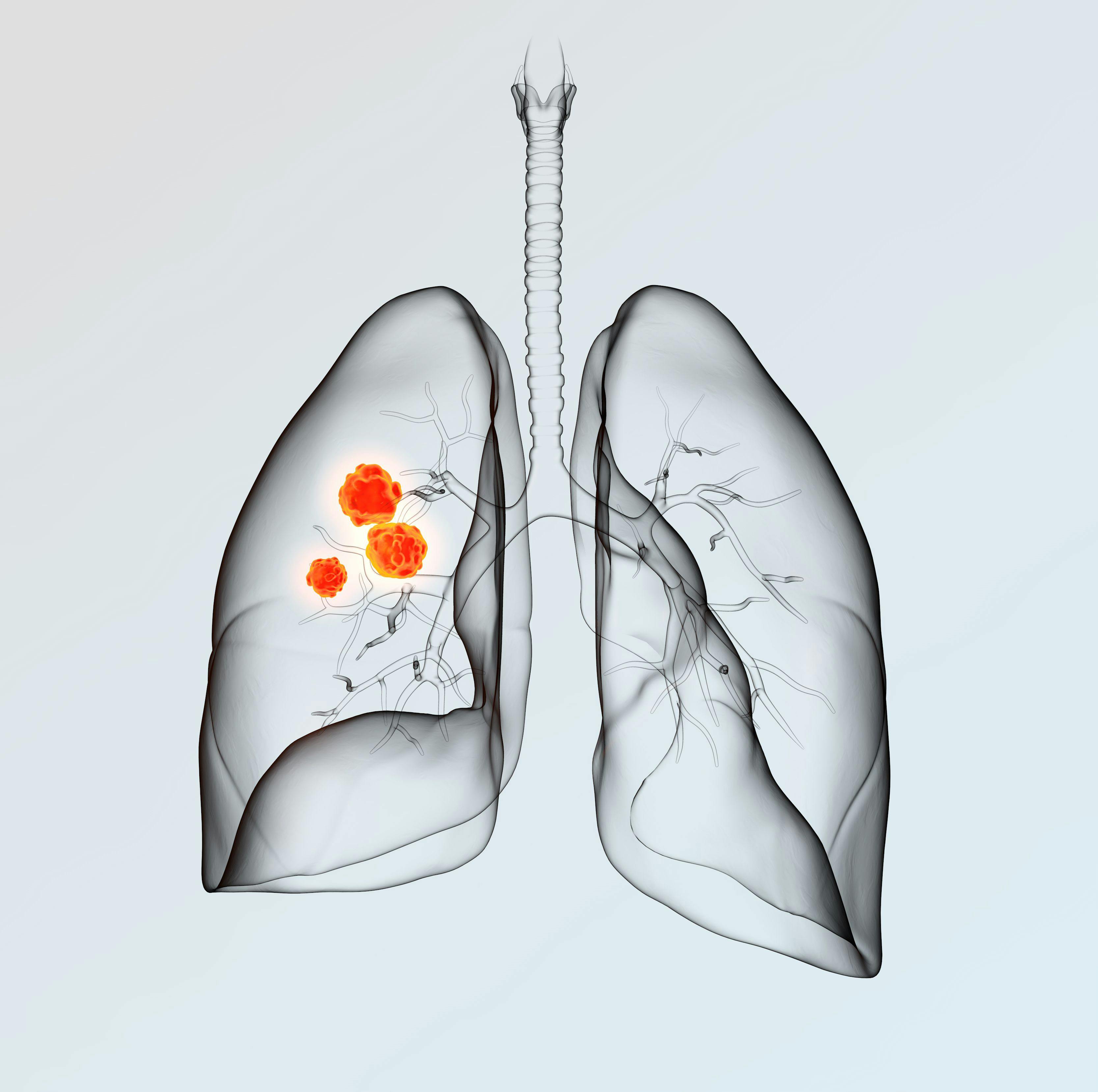 Lung cancer, medically 3D illustration on light background | Image Credit: © Axel Kock - www.stock.adobe.com