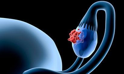 New Ovarian Cancer Guidelines Include Bevacizumab, Olaparib Approvals