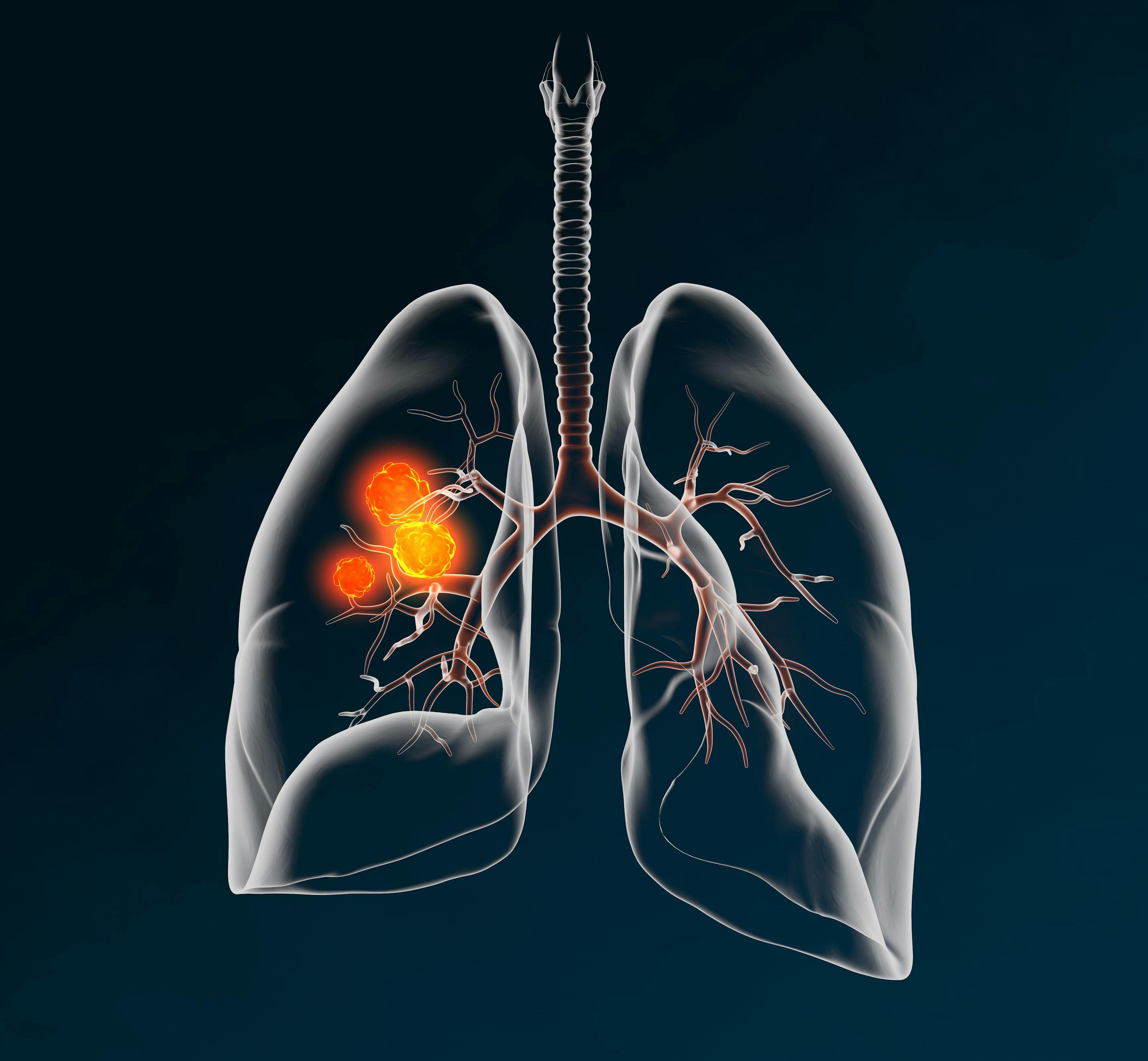 Lung cancer, medically 3D illustration on dark background | Image Credit: Axel Kock - www.stock.adobe.com