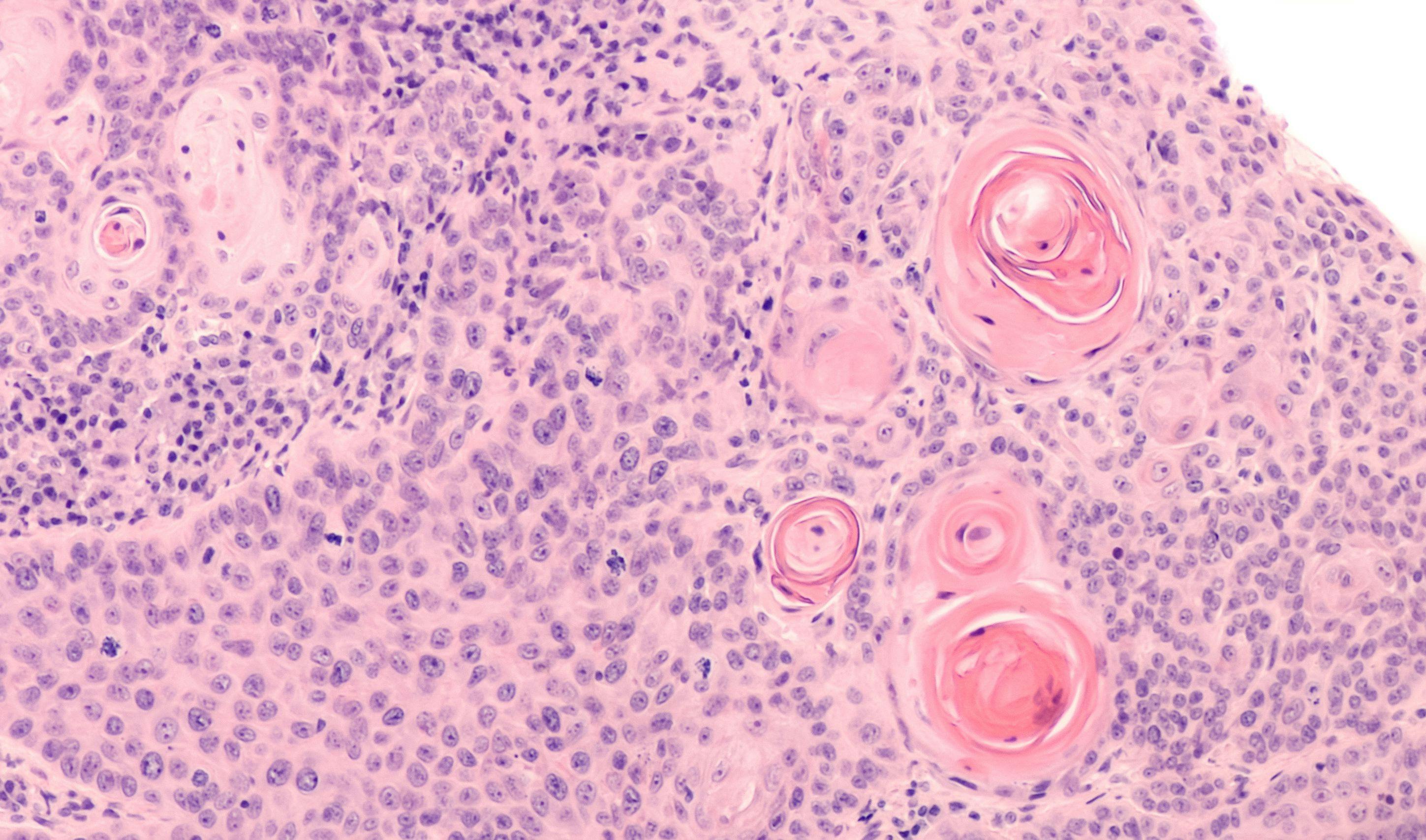 Lung Cancer: Photomicrograph of a CT (CAT) scan-guided needle core biopsy showing pulmonary squamous cell carcinoma, a type of non-small cell carcinoma usually associated with smoking | Image Credit: © David A Litman - stock.adobe.com 