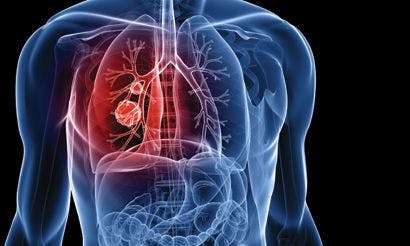 Study Findings Could Help Boost Lung Cancer Trial Enrollment