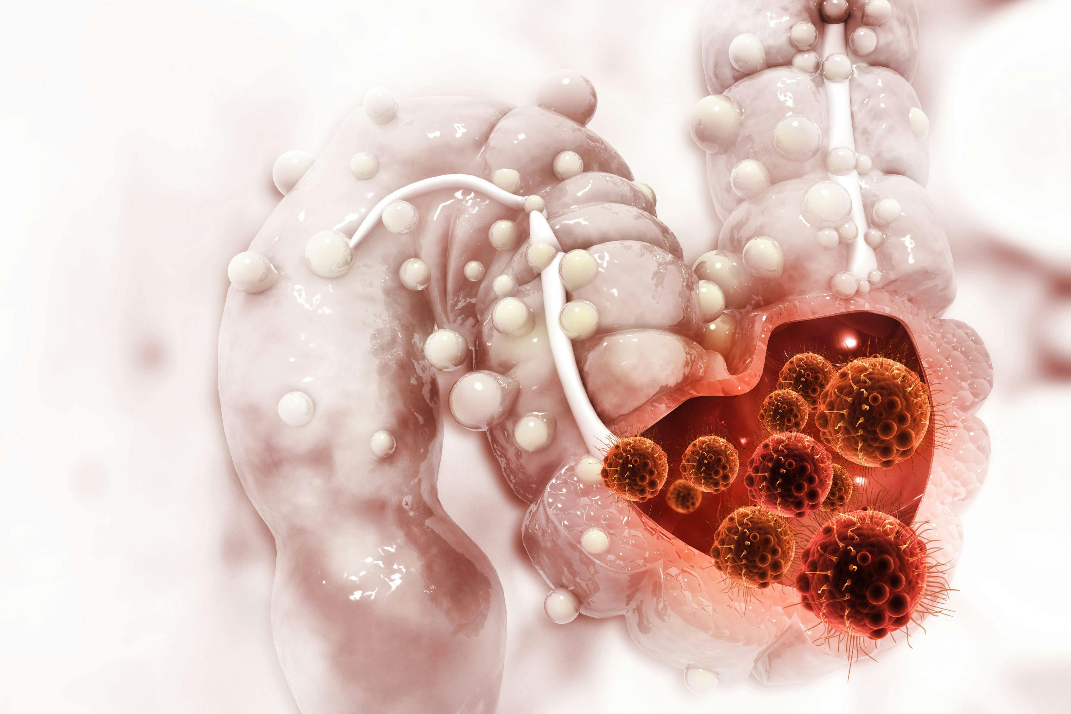 [Colon cancer. Cancer attacking cell. Colon disease concept. 3d illustration] Image Credit: ©  [Crystal light] - [stock.adobe.com]