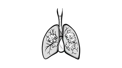 Experts Anticipate New Results From Sotorasib for KRAS G12C+ NSCLC