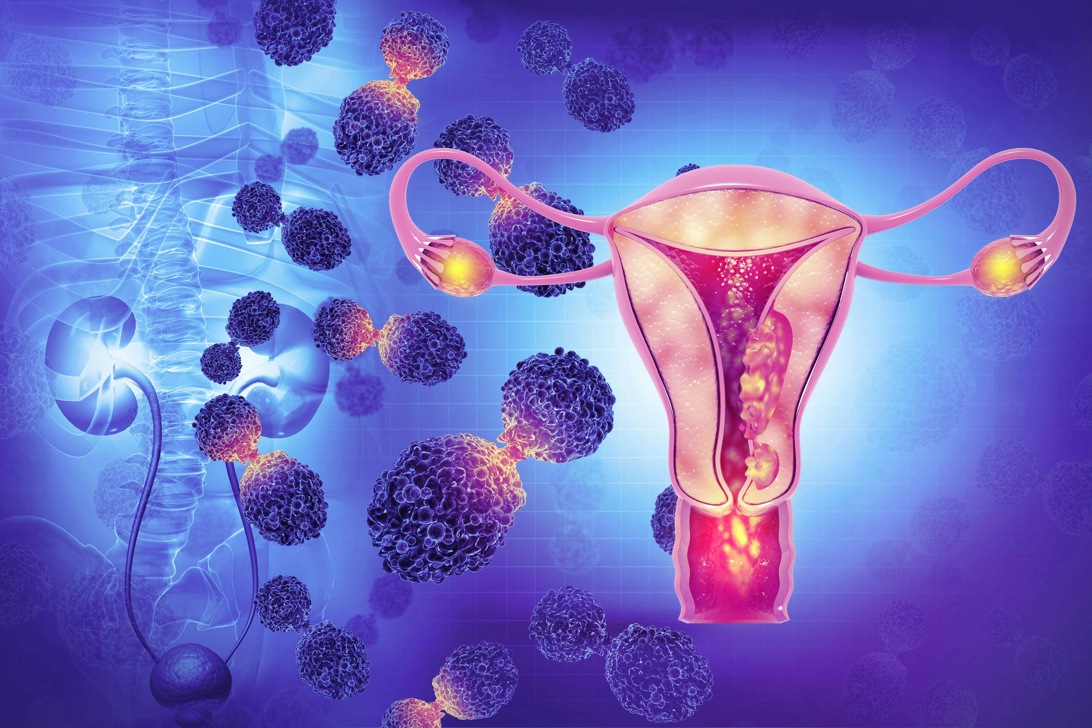 Female reproductive system diseases. Uterus cancer and endometrial malignant tumor as a uterine medical concept. 3d illustration | Image Credit: Crystal light - www.stock.adobe.com