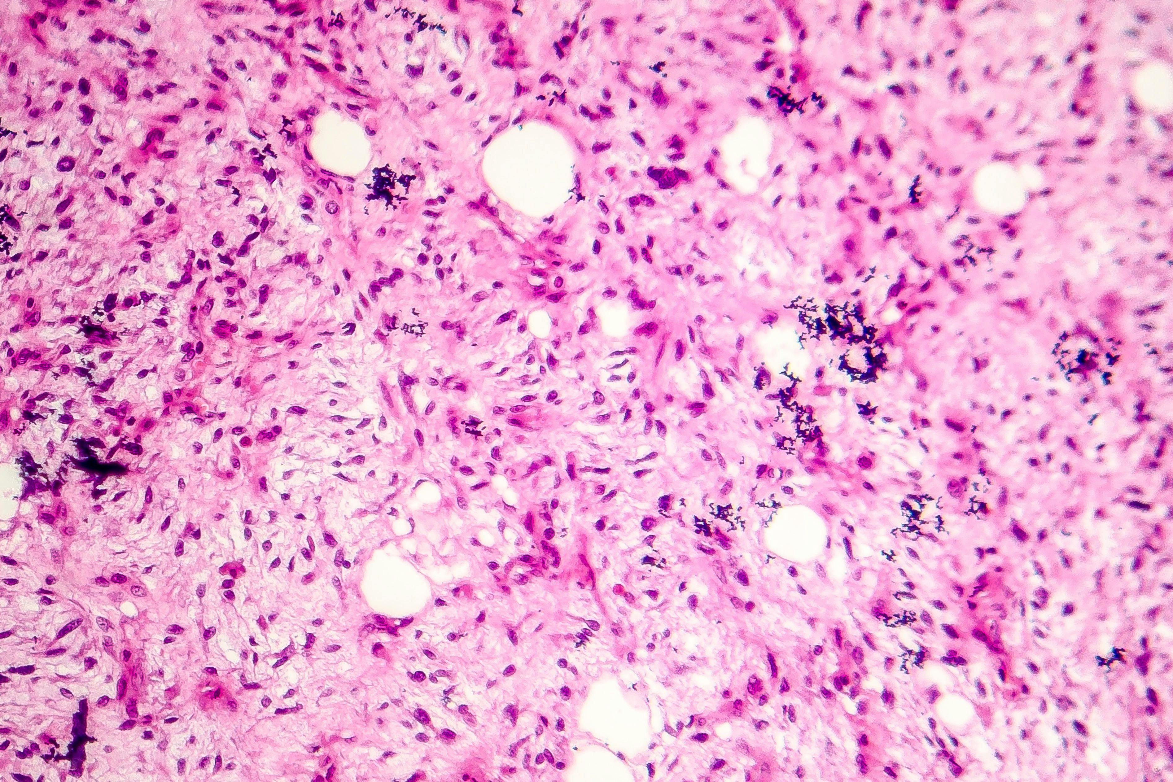 Liposarcoma, soft tissue sarcoma, light micrograph, photo under microscope | Image Credit: © Dr_Microbe - www.stock.adobe.com