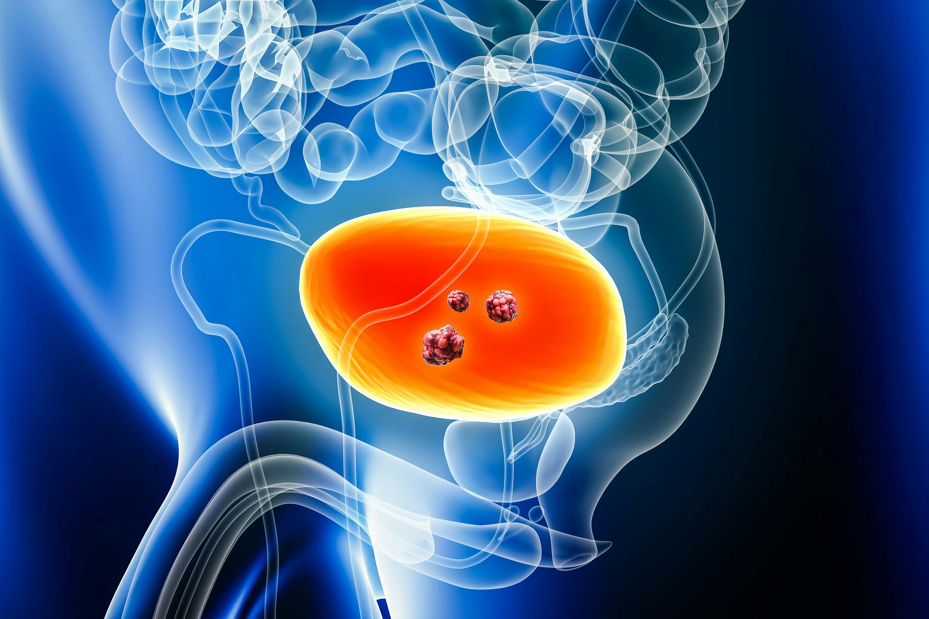 Urinary bladder cancer with organs and tumors or cancerous cells 3D rendering illustration with male body. Anatomy, oncology, biomedical, disease, medical, biology, science, healthcare concepts. | Image Credt: © Matthieu -  [stock.adobe.com]