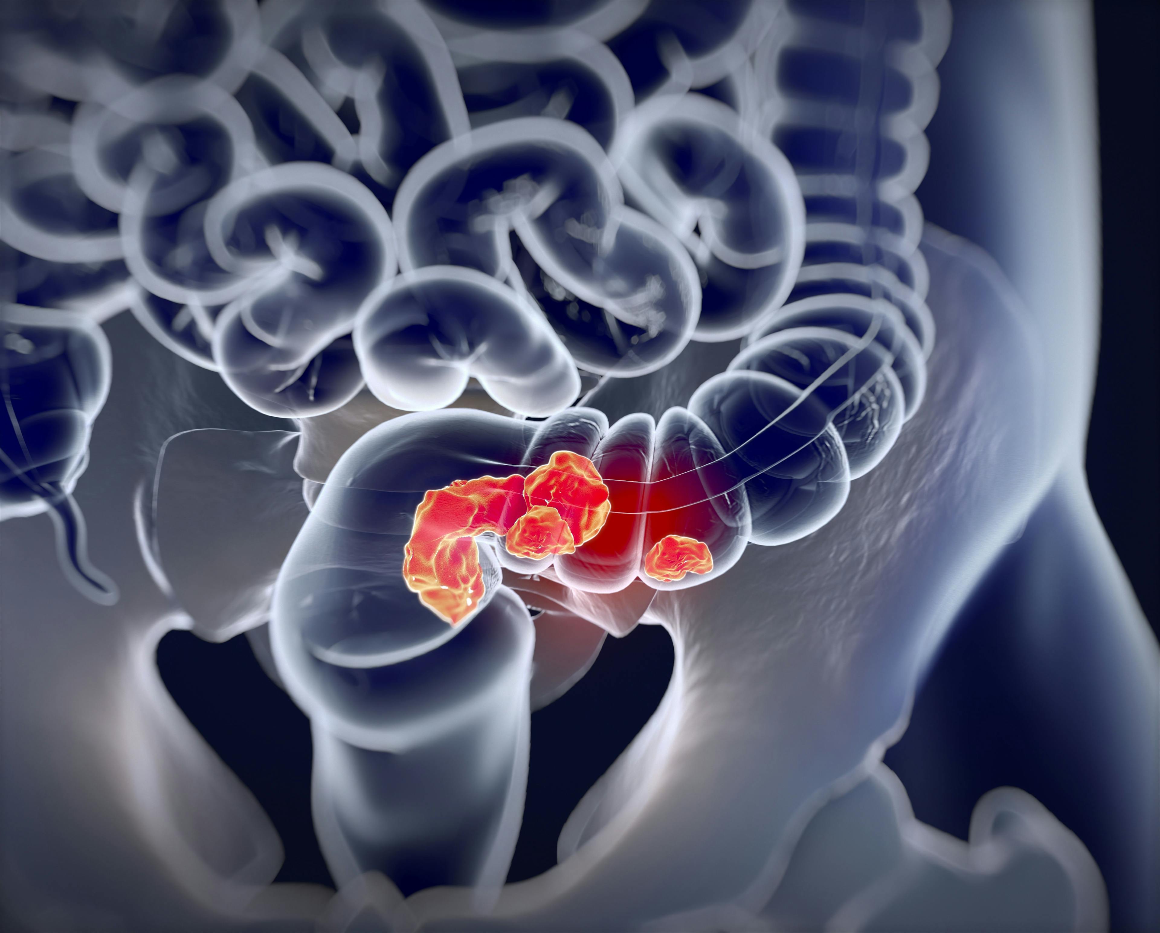3D illustration of colon cancer - stock.adobe.com
